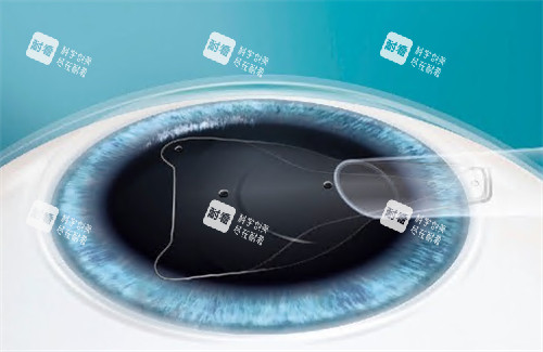 晶體植入手術(shù)過(guò)程圖解