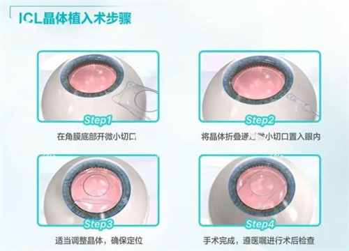 ICL晶體植入手術(shù) 步驟