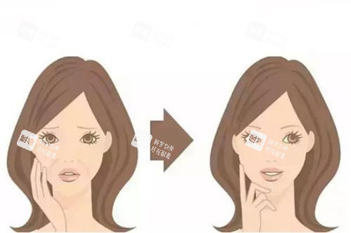 面部注射卡通對比圖