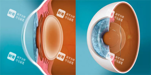 人工晶體植入正面和側(cè)面對(duì)比