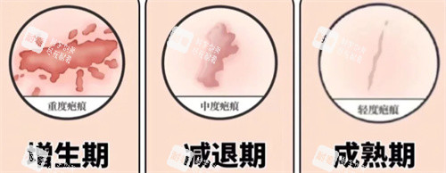 開眼角術(shù)后疤痕期