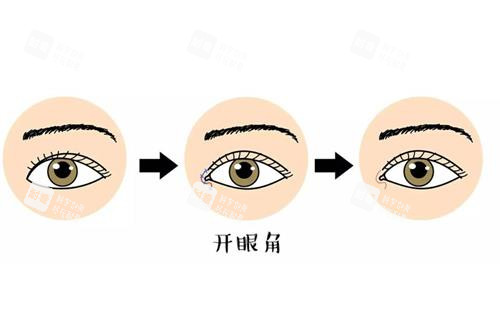 開眼角前后對(duì)比漫畫圖