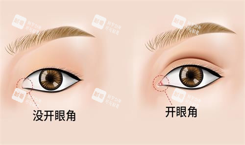 開眼角前后對(duì)比圖