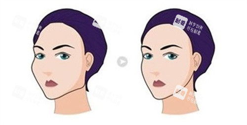 項昌峰磨骨技術(shù)揭秘：長曲線截骨+雙重固定，術(shù)后下頜線流暢度拉滿