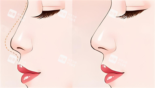 隆鼻前后對比動(dòng)畫圖