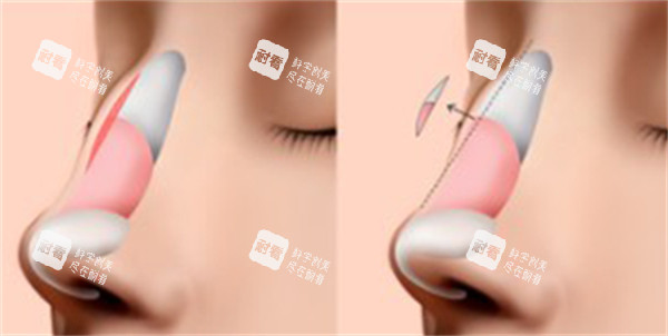 韓國隆鼻前后圖片