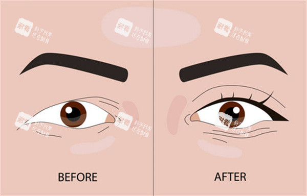 埋線雙眼皮整形