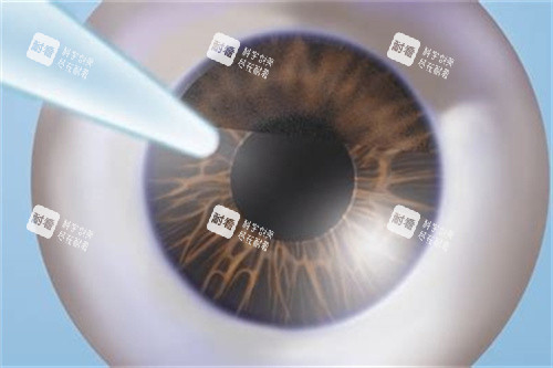 準(zhǔn)分子激光