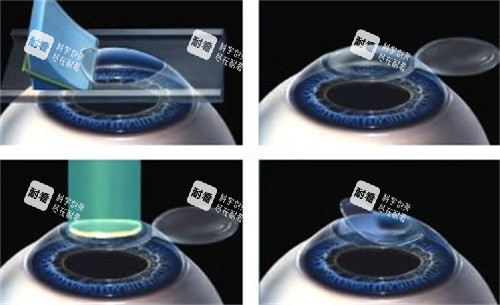 準(zhǔn)分子激光手術(shù)過程