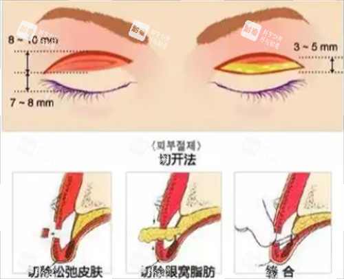 切開雙眼皮手術(shù) 切開雙眼皮手術(shù)