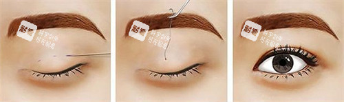 正在進(jìn)行的雙眼皮手術(shù) 正在進(jìn)行的雙眼皮手術(shù)