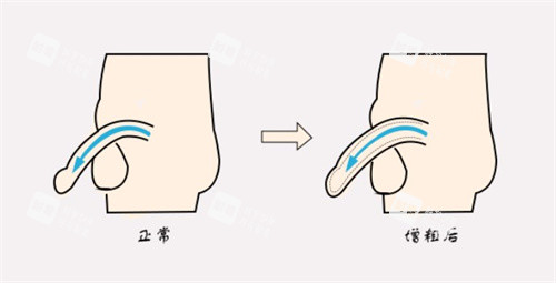 增粗術(shù)前后對(duì)比
