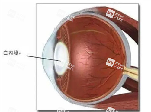 治療白內(nèi)障
