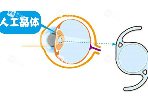 白內(nèi)障晶體植入