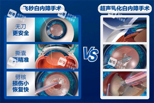 飛秒白內(nèi)障手術(shù)過(guò)程