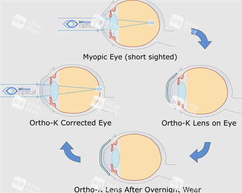 角膜塑形鏡前后對(duì)比