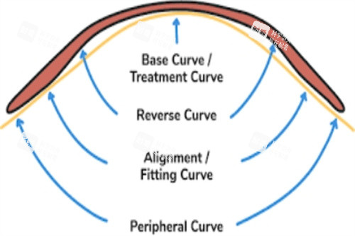 角膜塑形鏡作用示意圖