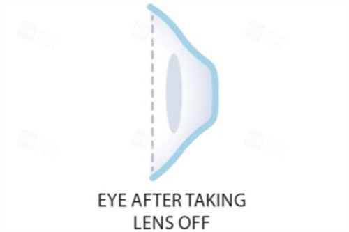 取下角膜塑形鏡后 取下角膜塑形鏡后