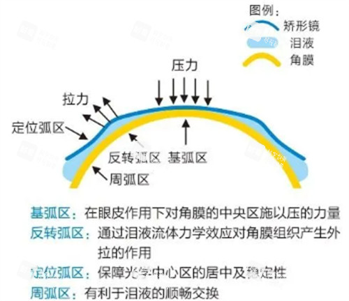 角膜塑形鏡功效圖示 角膜塑形鏡功效圖示