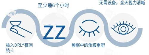 角膜塑形鏡矯正過程