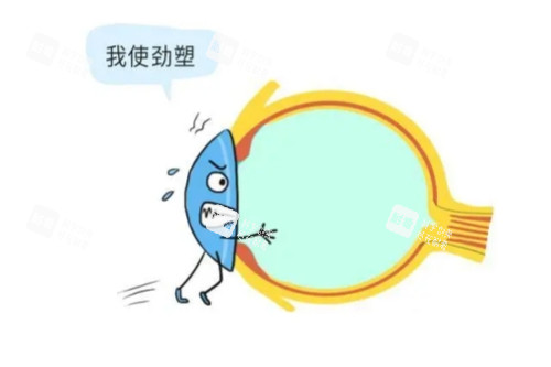 角膜塑形鏡卡通概念圖