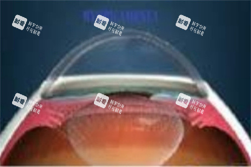 角膜塑形鏡1