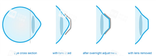 角膜塑形鏡可以改善眼表曲度