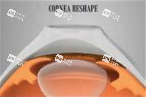 角膜塑形鏡3副本