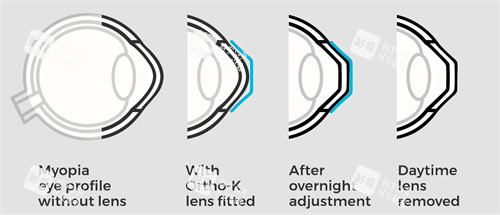 角膜塑形鏡改善流程