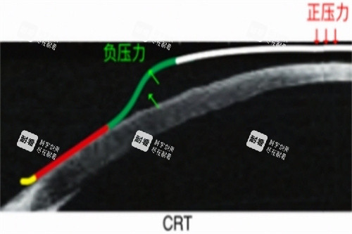 CRT角膜塑形鏡力的示意圖