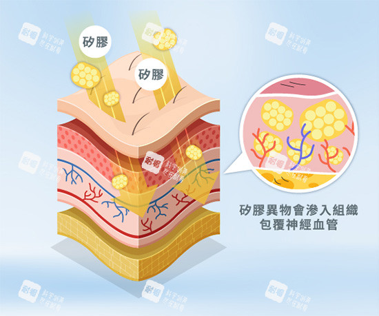 饅化針注射示意圖