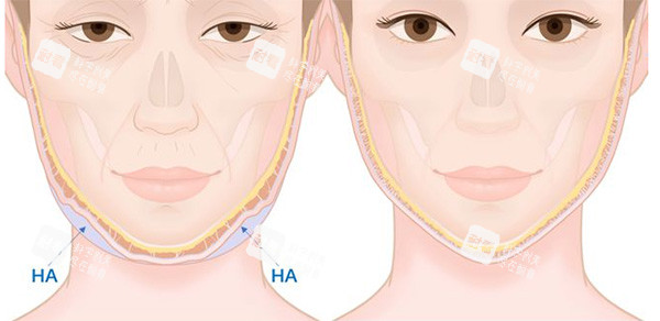 饅化臉改善前后變化 饅化臉改善前后變化