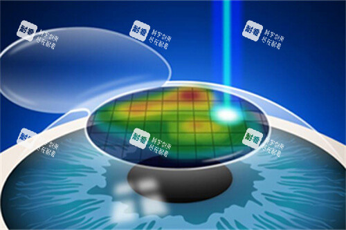 近視手術(shù)漫畫示意圖