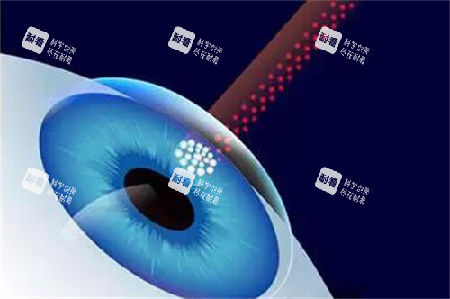 近視眼手術(shù)漫畫示意圖