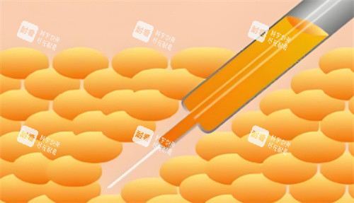 吸脂手術(shù)圖