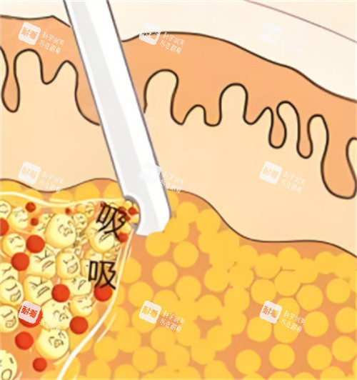 吸脂手術(shù)動(dòng)畫