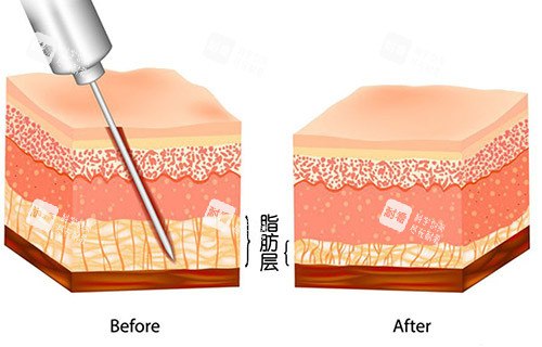 吸脂手術(shù)層級示意圖