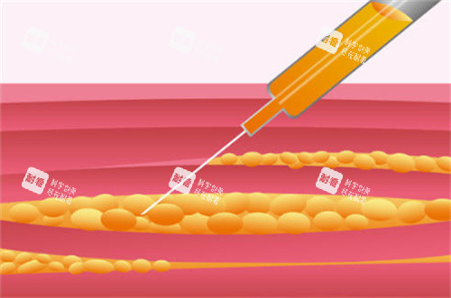 吸脂手術(shù)過程原理卡通圖