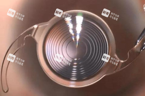 白內(nèi)障多焦點(diǎn)人工晶體能報(bào)銷嗎？集中采購降價(jià)60%后，不同晶體成本分擔(dān)差異及經(jīng)濟(jì)支持要點(diǎn)梳理