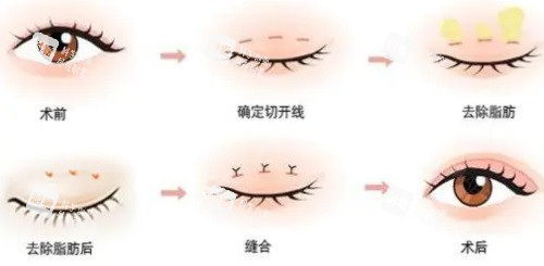 雙眼皮手術(shù)過程圖