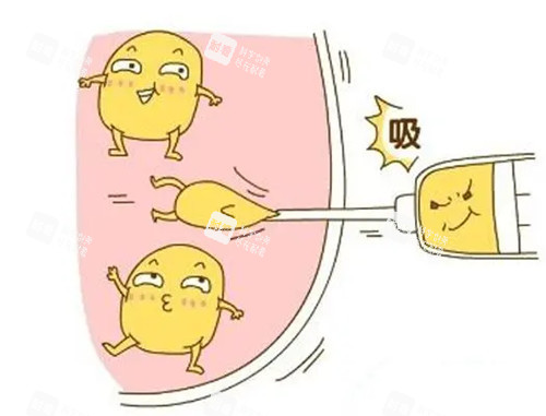 吸脂卡通示意圖