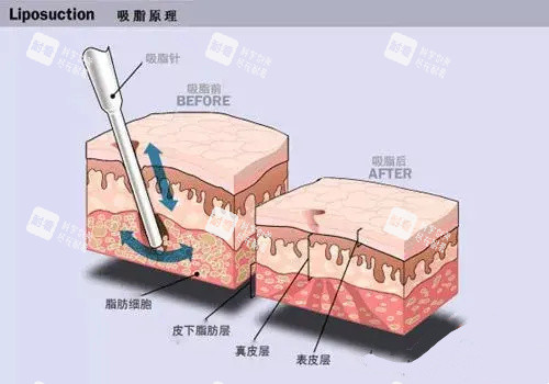 北京王東脂肪修復怎么樣？專治填充饅化、硬塊，修復后皮膚平整