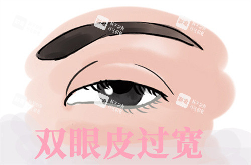 雙眼皮過寬修復(fù)