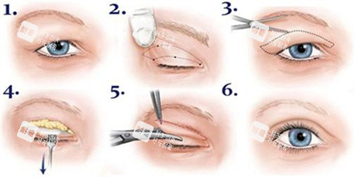 雙眼皮全切術(shù)過程圖 雙眼皮全切術(shù)過程圖