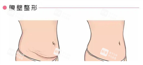 腹壁成形術(shù)前后對(duì)比圖 腹壁成形術(shù)前后對(duì)比圖