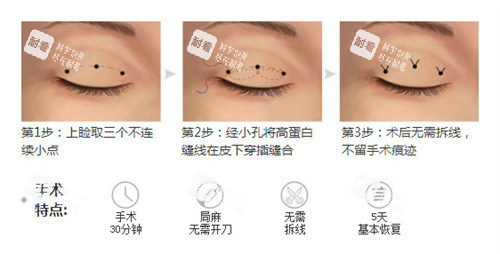 雙眼皮三點(diǎn)術(shù)過(guò)程特點(diǎn) 雙眼皮三點(diǎn)術(shù)過(guò)程特點(diǎn)