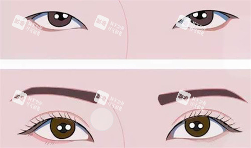 雙眼皮前后對(duì)比