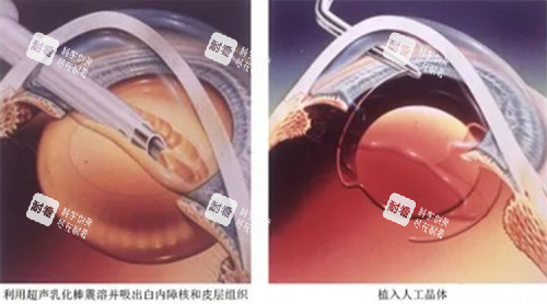 超聲乳化白內(nèi)障 超聲乳化白內(nèi)障