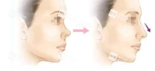 北京鼻子整形手術(shù)價(jià)格：縮鼻翼、墊鼻尖、駝峰鼻矯正分開(kāi)算，附實(shí)例！