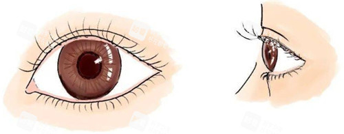 瞼內(nèi)翻卡通圖